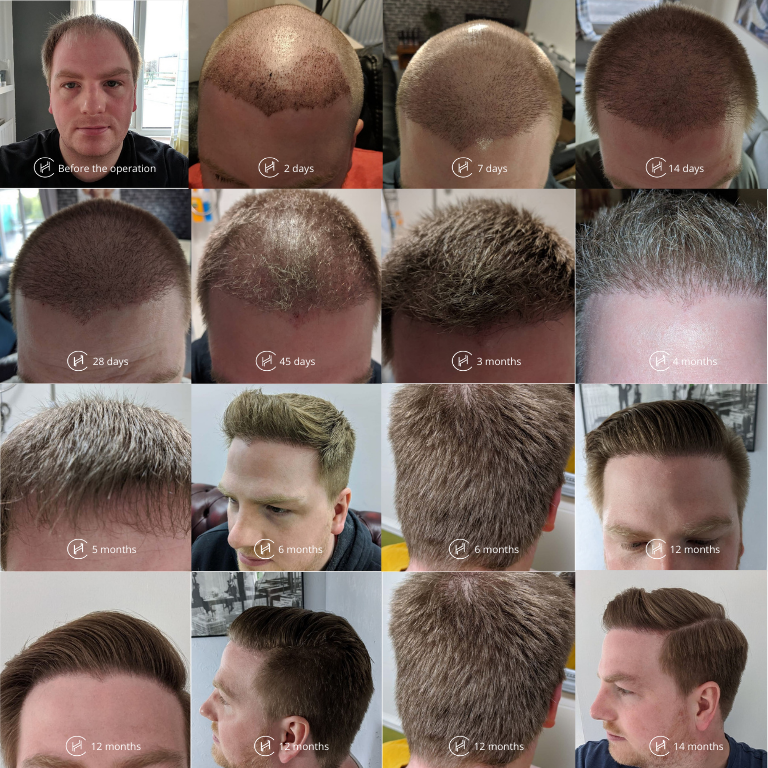 Top More Than Hair Transplant Care After Surgery Best In Eteachers