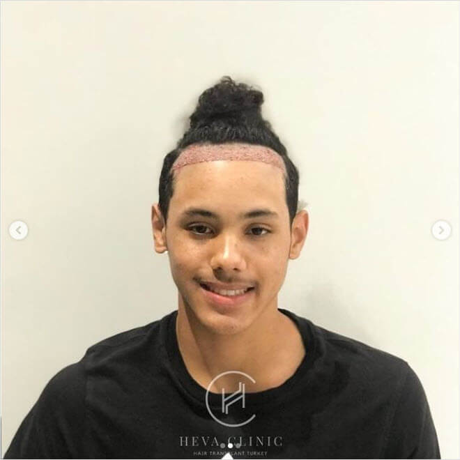 DHI hair transplant patient smiling