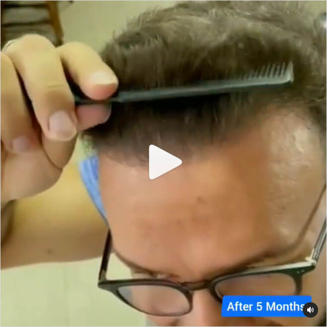 فيديو ما بعد زراعة الشعر في عيادة هيفا