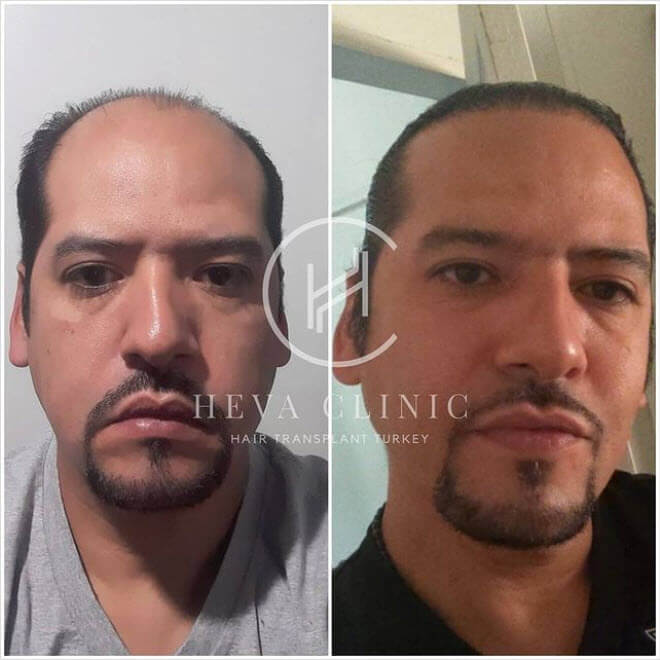 قبل وبعد إجراء عملية زراعة شعر للرجال في عيادة هيفا في اسطنبول