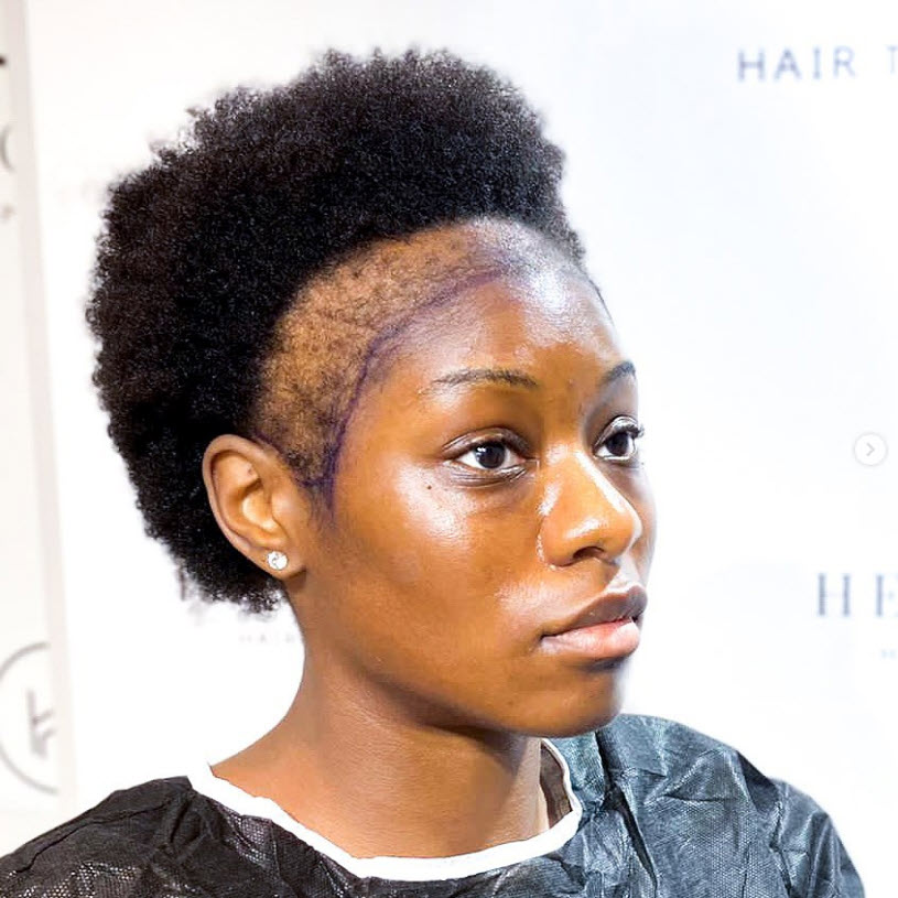 تساقط الشعر عند النساء الأفريقيات قبل زراعة الشعر