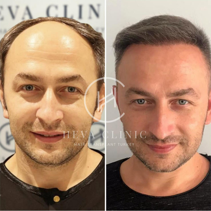 صور قبل وبعد لزراعة الشعر في تركيا - صور زراعة الشعر قبل وبعد لم تتم تصفيته
