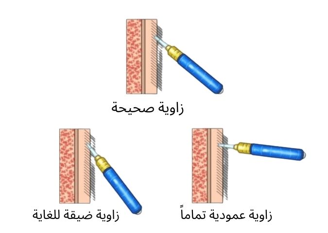 زراعة-الشعر-خطوات