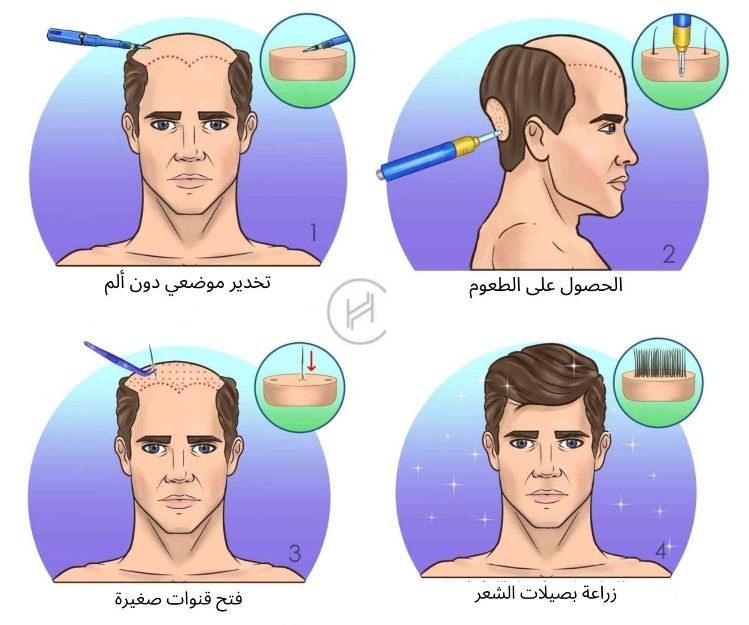 عملية-زراعة-الشعر