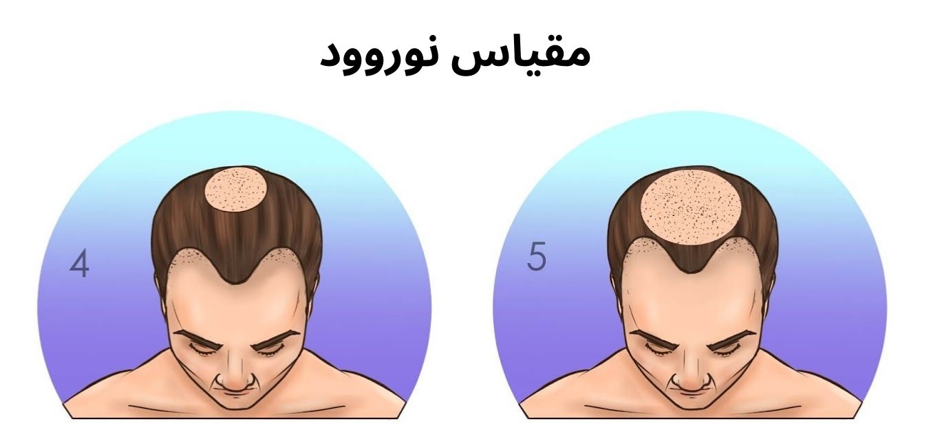 مقياس-نوروود (1)