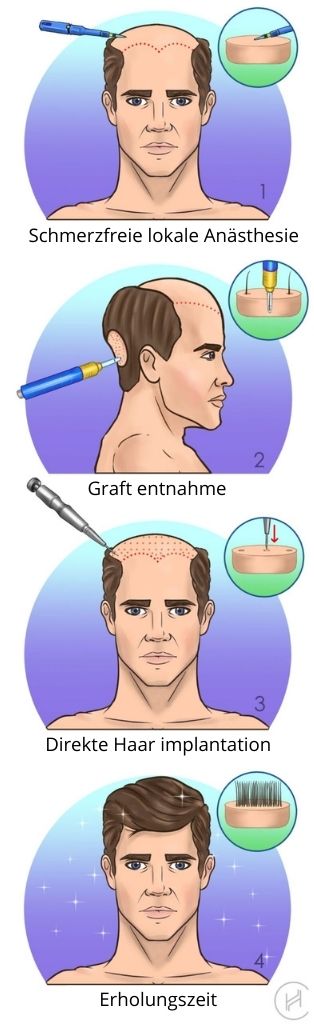 DHI-Haartransplantation