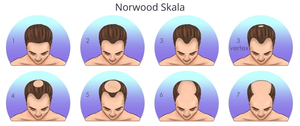 Norwood Skala für Haarausfall