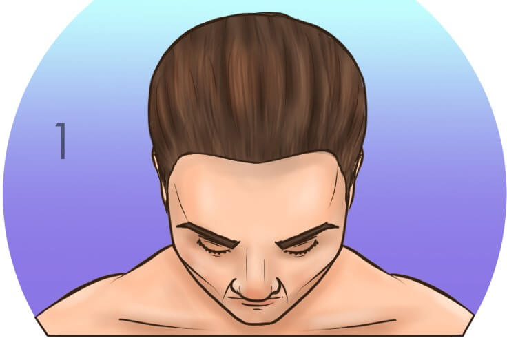 Stufe 1 Norwood-Skala für Haarausfall