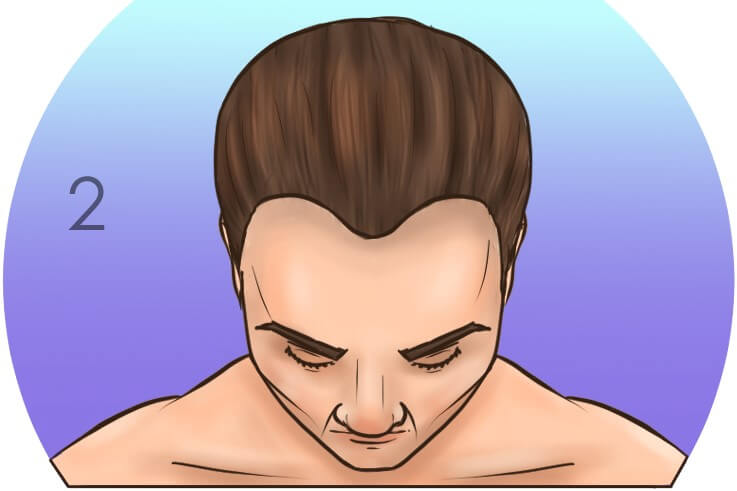 stufe 2 Norwood-Skala für Haarausfall