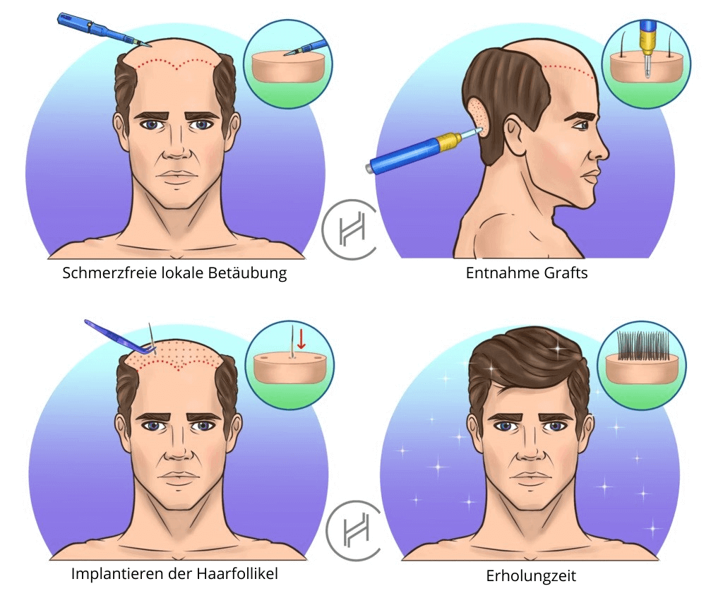 5000 Grafts Haartransplantationsprozess quadratisch