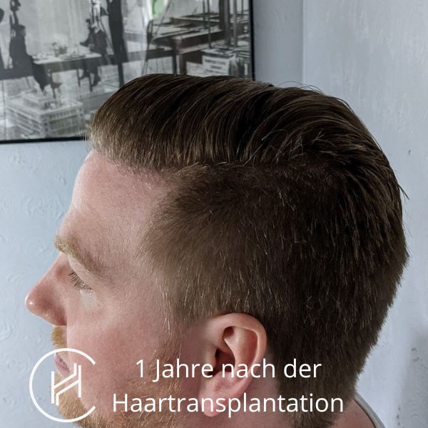 12 Monat nach der Haartransplantation