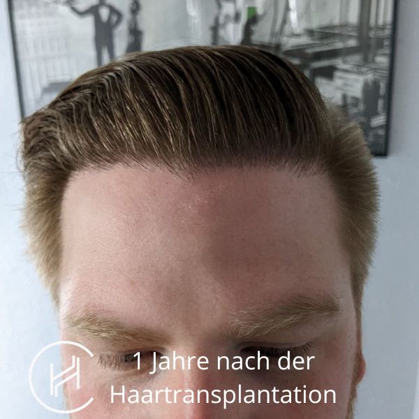 1 Jahre nach der Haartransplantation