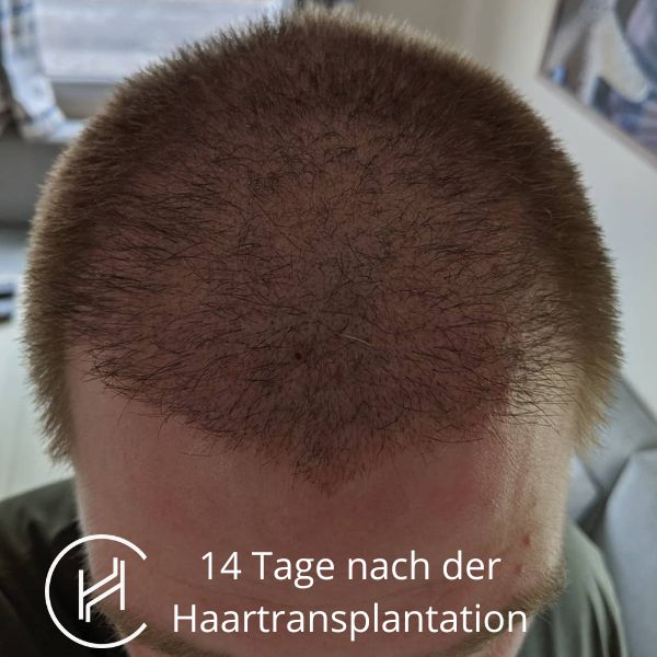 14 Tage nach der Haartransplantation