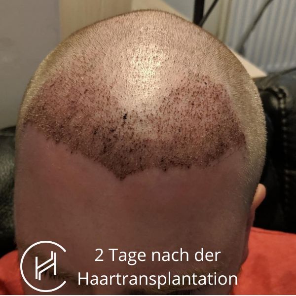 2 Tage nach der Haartransplantation