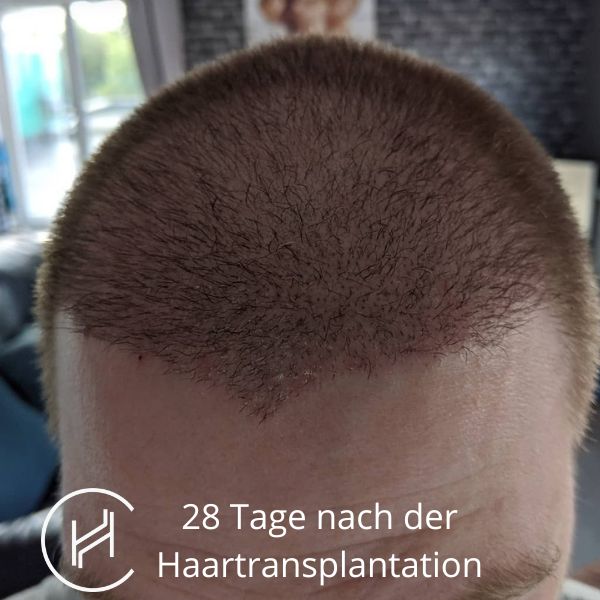 28 Tage nach der Haartransplantation