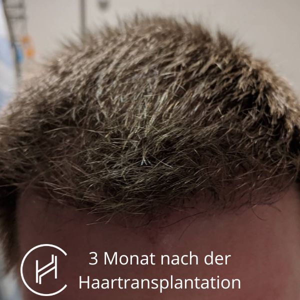 3 Monat nach der Haartransplantation