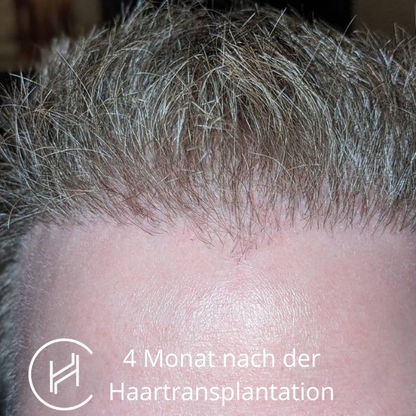 4 Monat nach der Haartransplantation