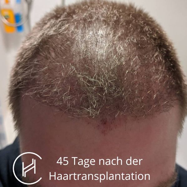 45 Tage nach der Haartransplantation
