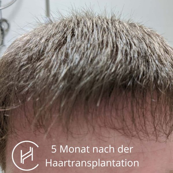 5 Monat nach der Haartransplantation