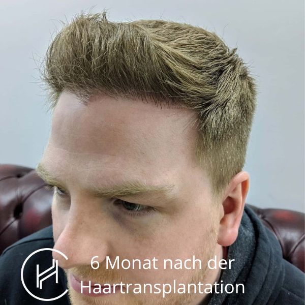 6 Monat nach der Haartransplantation