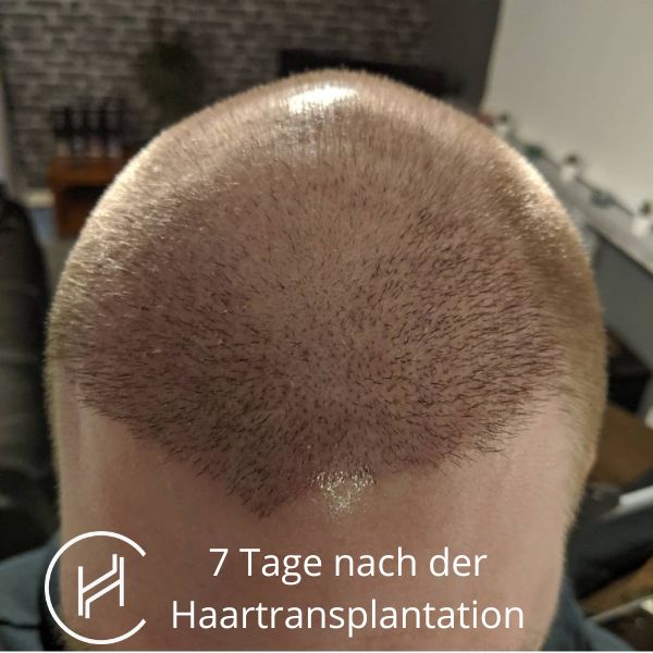 7 Tage nach der Haartransplantation