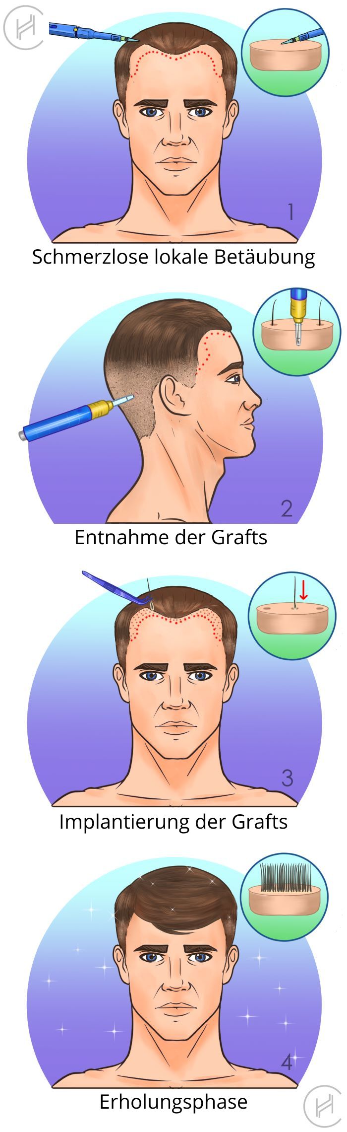 Haartransplantation ohne Rasur Verfahren