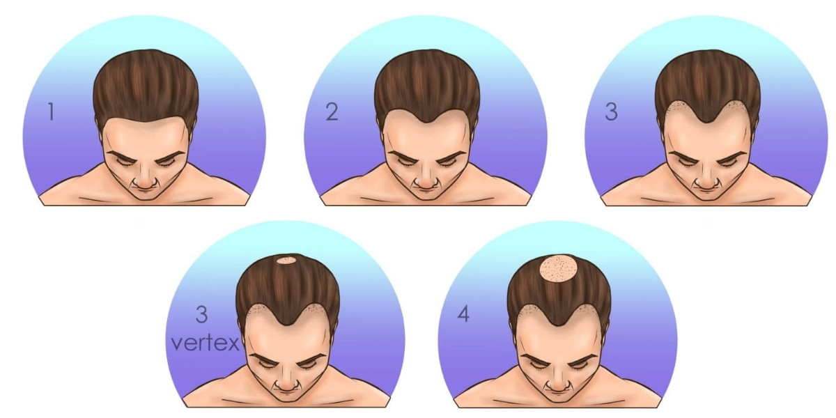 Ohne Rasur Haartransplantationskandidat Norwood 1-2-3-4