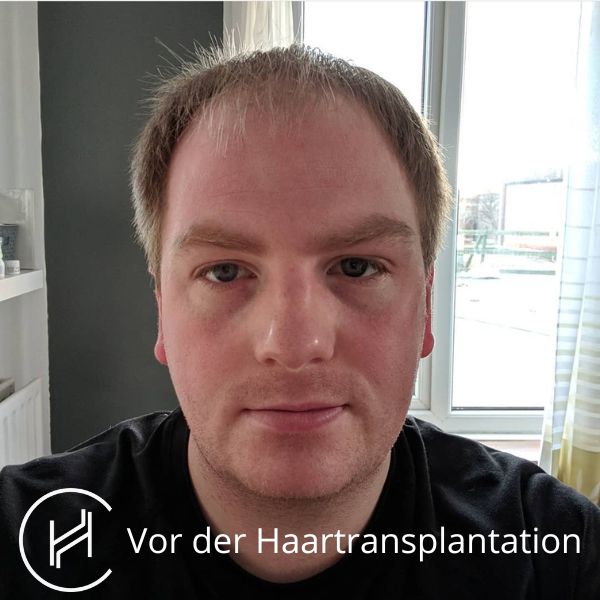 Vor der Haartransplantation