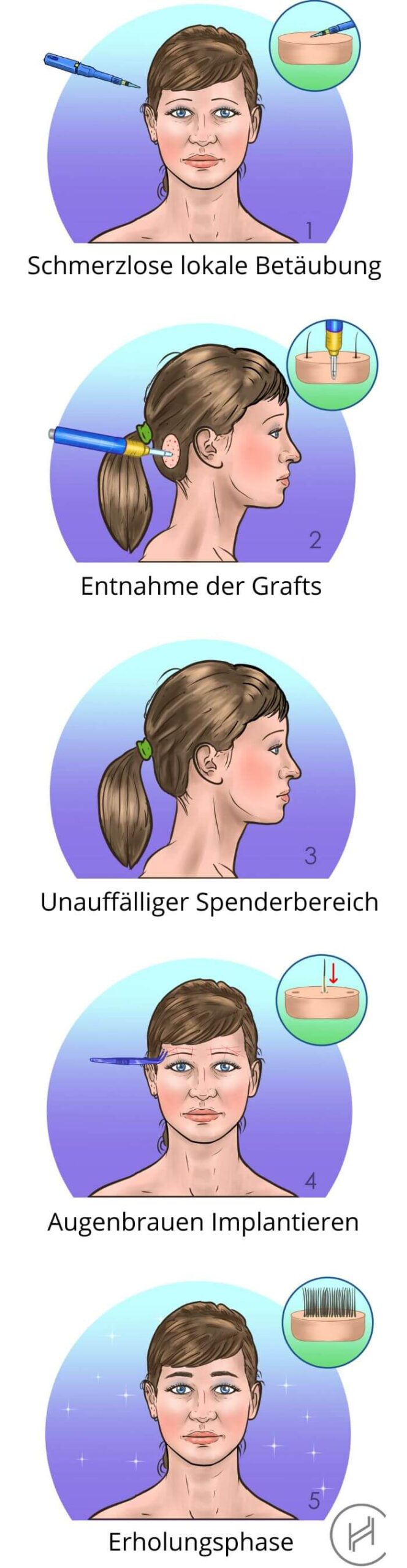Ablauf einer Augenbrauentransplantation Ablauf einer Augenbrauentransplantation