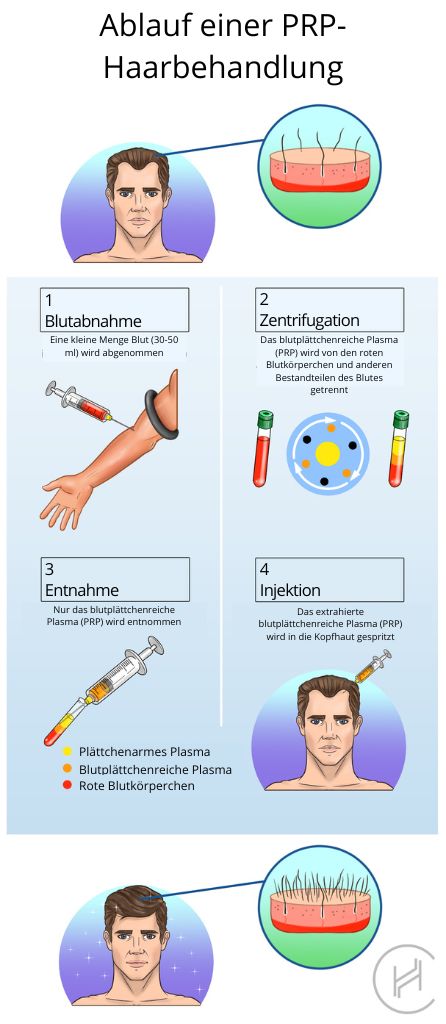 Ablauf einer PRP-Haarbehandlung