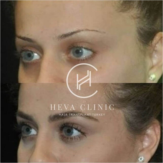 Augenbrauen implantieren heva clinic in Istanbul, Türkei