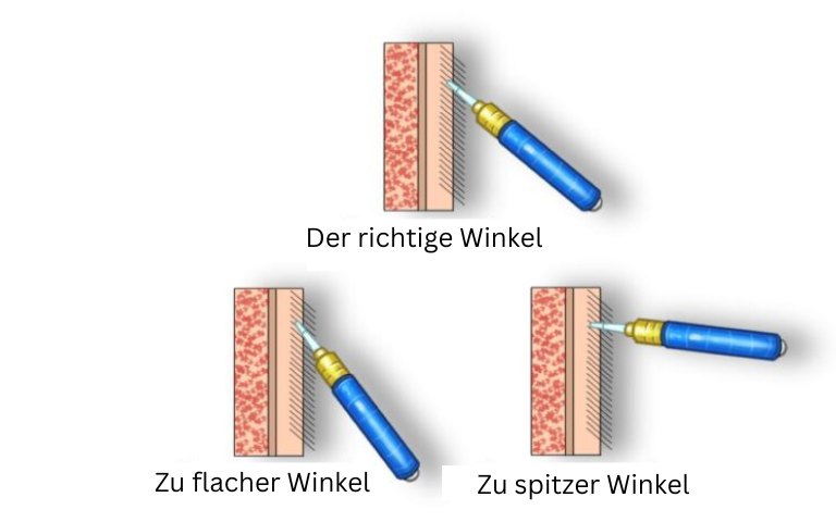 Die richtige Extraktionsmethode und der richtige -winkel Haartransplantationen