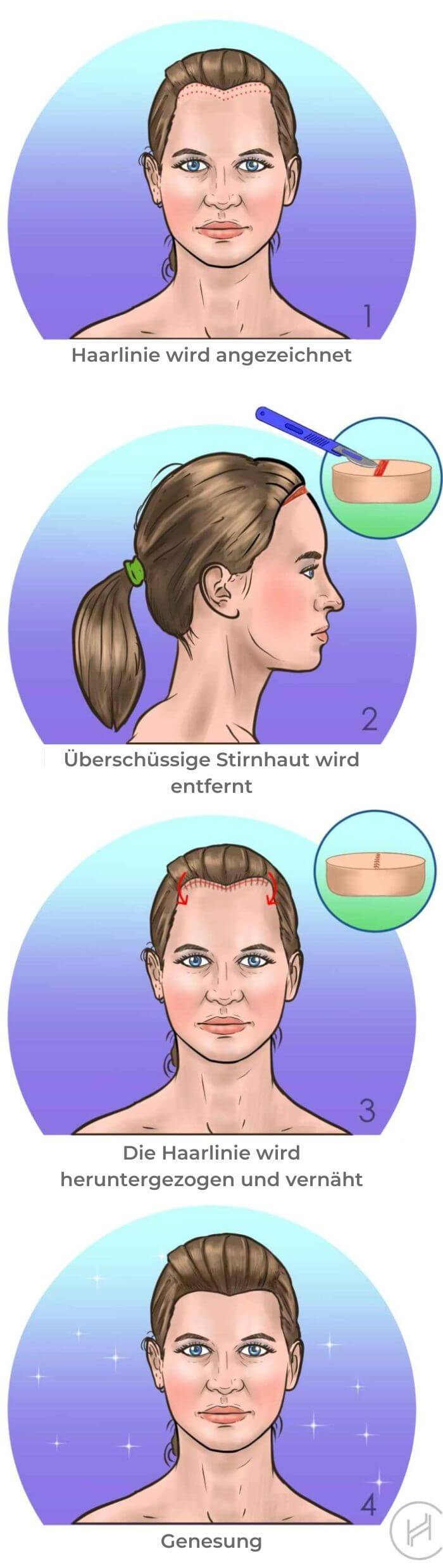 Stirnverkleinerung-Prozessschritte