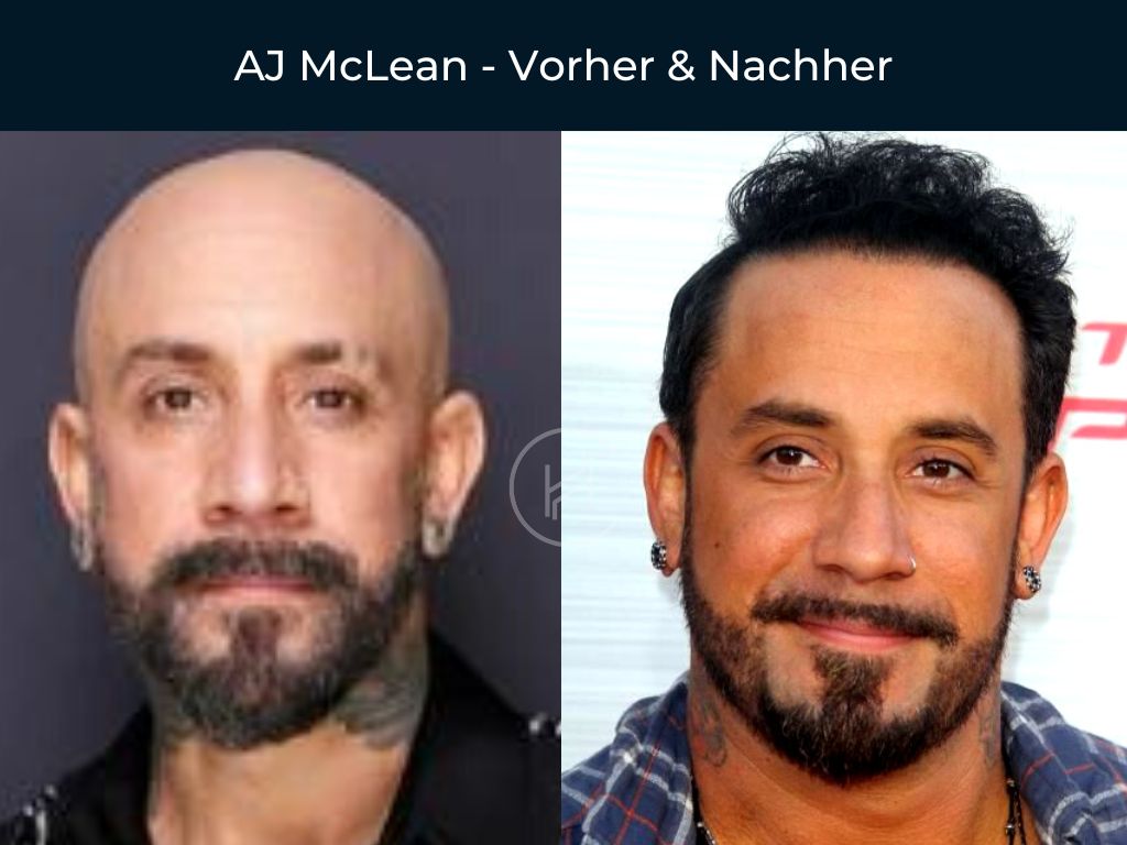 AJ McLean - Vorher & Nachher Haartransplantation AJ McLean - Vorher & Nachher Haartransplantation