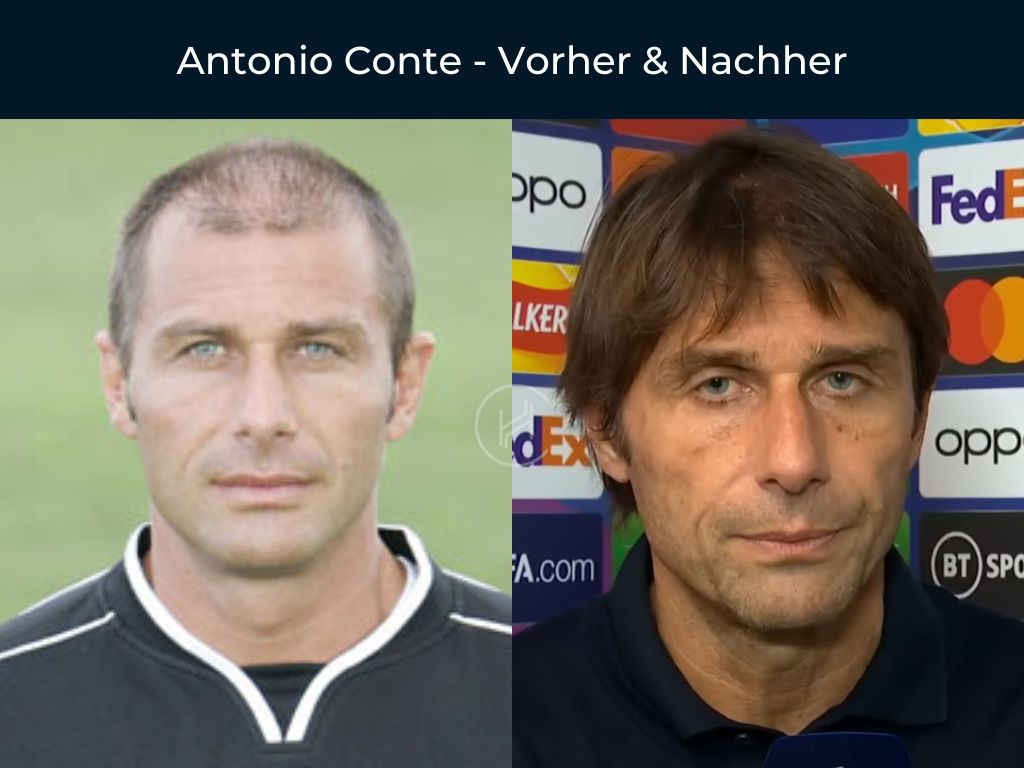 Antonio Conte - Vorher & Nachher Haartransplantation Antonio Conte - Vorher & Nachher Haartransplantation