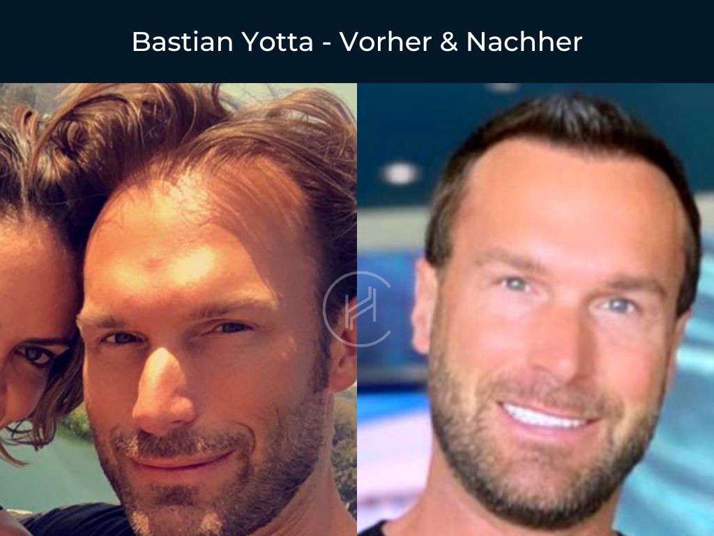 Bastian Yotta - Vorher & Nachher Haartransplantation
