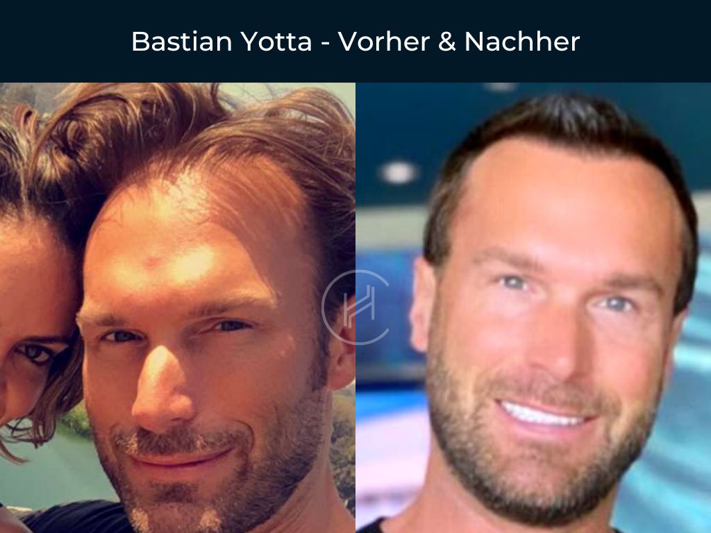 Bastian Yotta - Vorher & Nachher Haartransplantation Bastian Yotta - Vorher & Nachher Haartransplantation