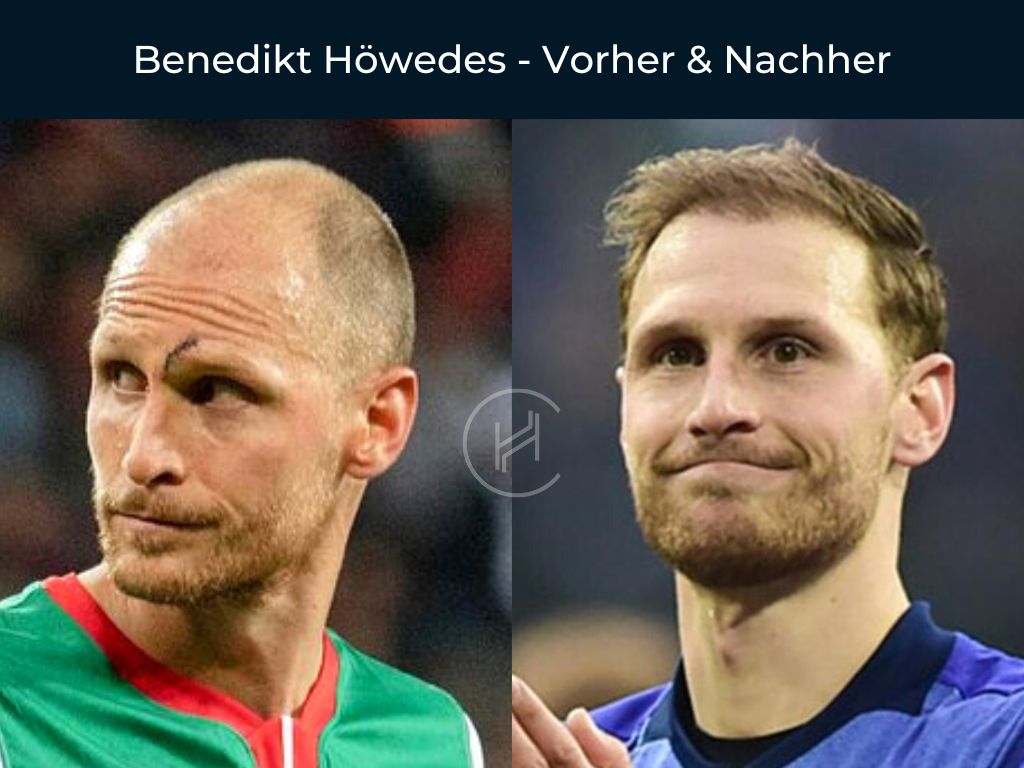 Benedikt Höwedes - Vorher & Nachher Haartransplantation Benedikt Höwedes - Vorher & Nachher Haartransplantation