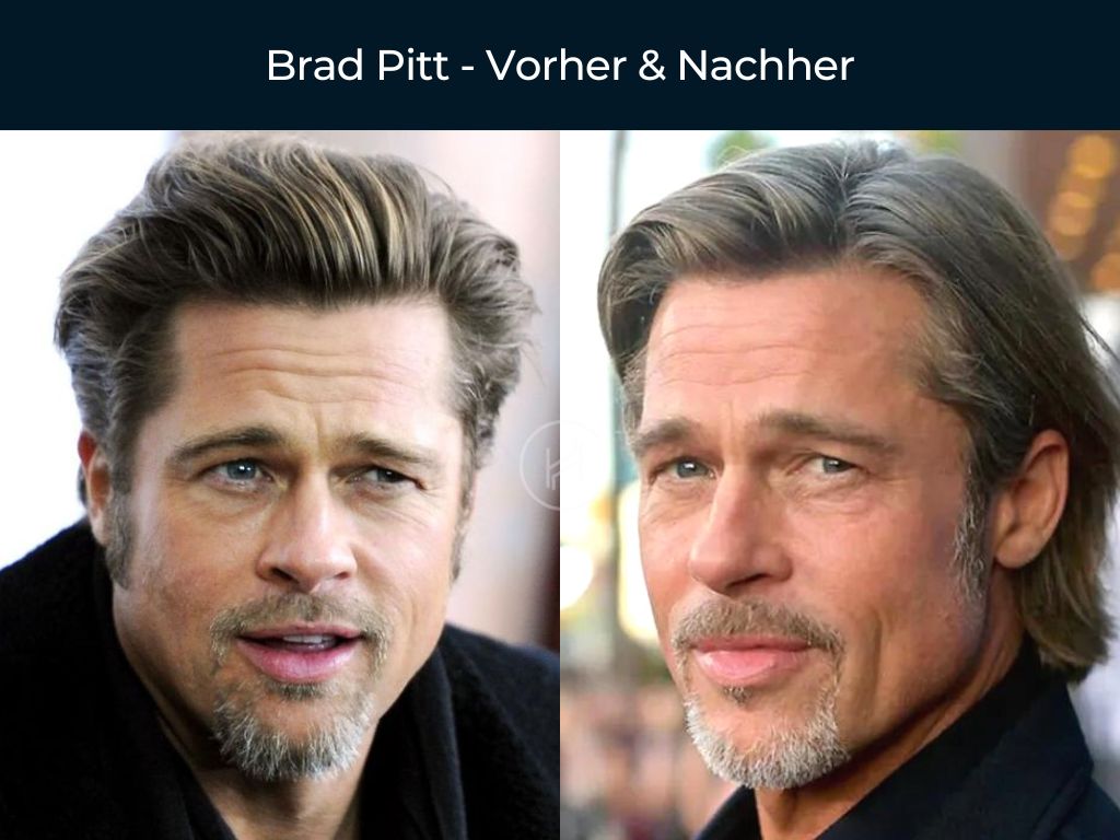Brad Pitt - Vorher & Nachher Haartransplantation
