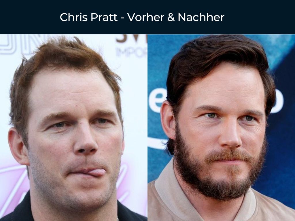 Chris Pratt - Vorher & Nachher Haartransplantation Chris Pratt - Vorher & Nachher Haartransplantation