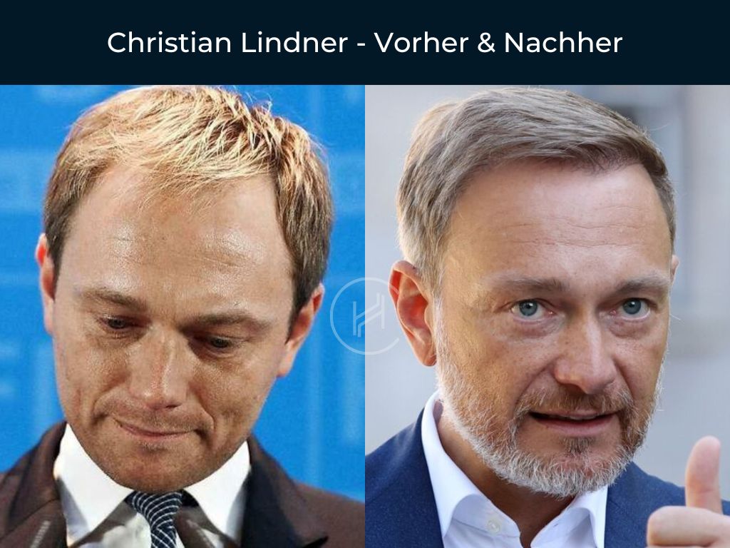 Christian Lindner - Vorher & Nachher Haartransplantation
