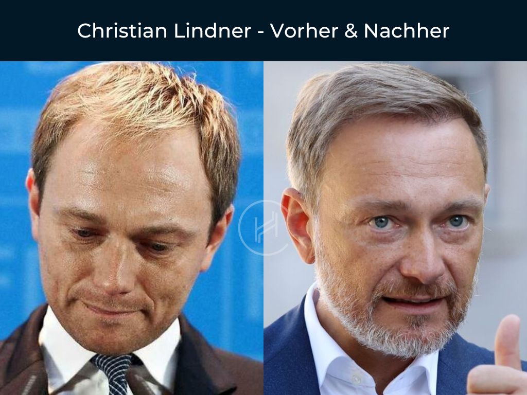Christian Lindner - Vorher & Nachher Haartransplantation Christian Lindner - Vorher & Nachher Haartransplantation