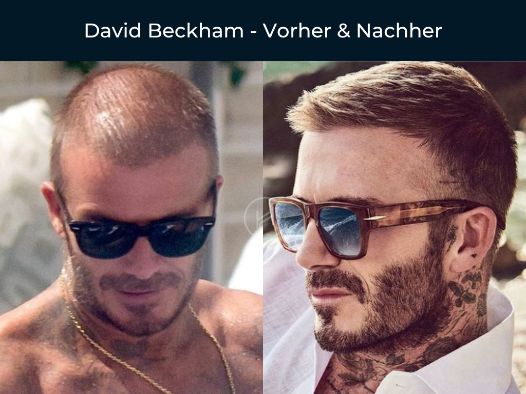 David Beckham - Vorher & Nachher Haartransplantation David Beckham - Vorher & Nachher Haartransplantation