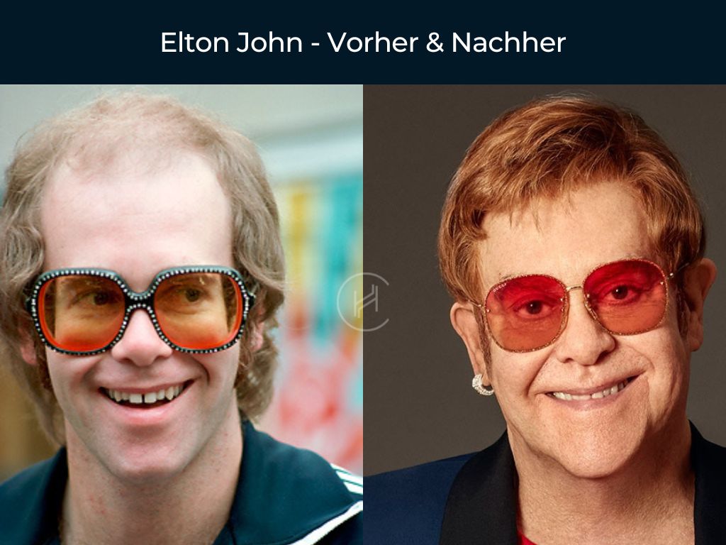 Elton John - Vorher & Nachher Haartransplantation