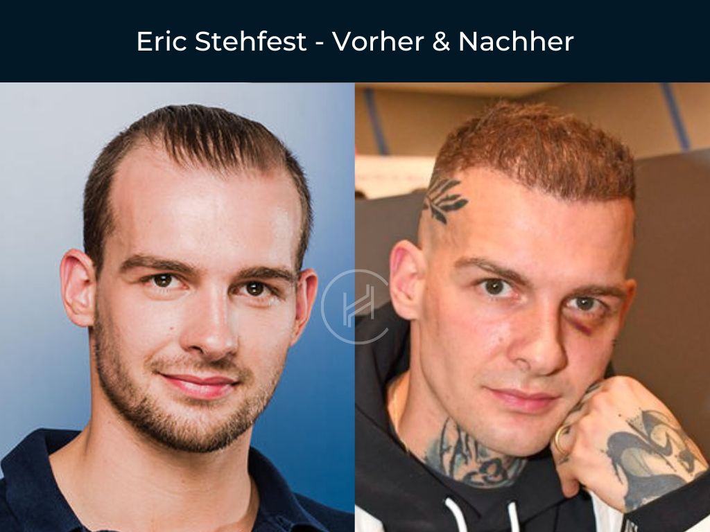Eric Stehfest - Vorher & Nachher Haartransplantation Eric Stehfest - Vorher & Nachher Haartransplantation