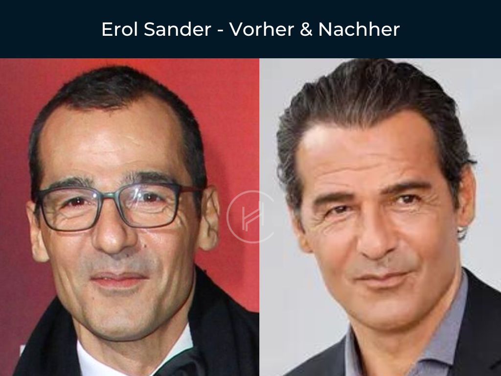 Erol Sander - Vorher & Nachher Haartransplantation Erol Sander - Vorher & Nachher Haartransplantation