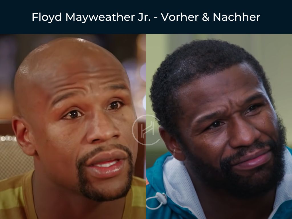 Floyd Mayweather Jr. - Vorher & Nachher Haartransplantation Floyd Mayweather Jr. - Vorher & Nachher Haartransplantation