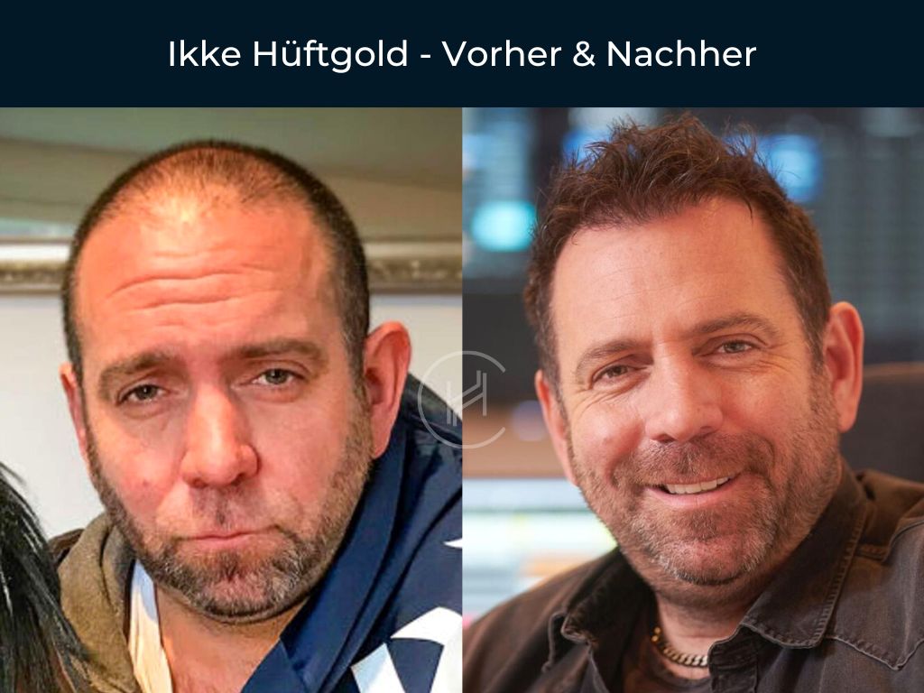 Ikke Hüftgold - Vorher & Nachher Haartransplantation