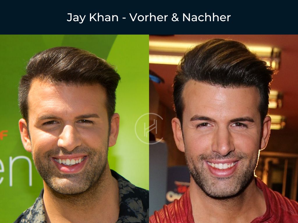 Jay Khan - Vorher & Nachher Haartransplantation Jay Khan - Vorher & Nachher Haartransplantation