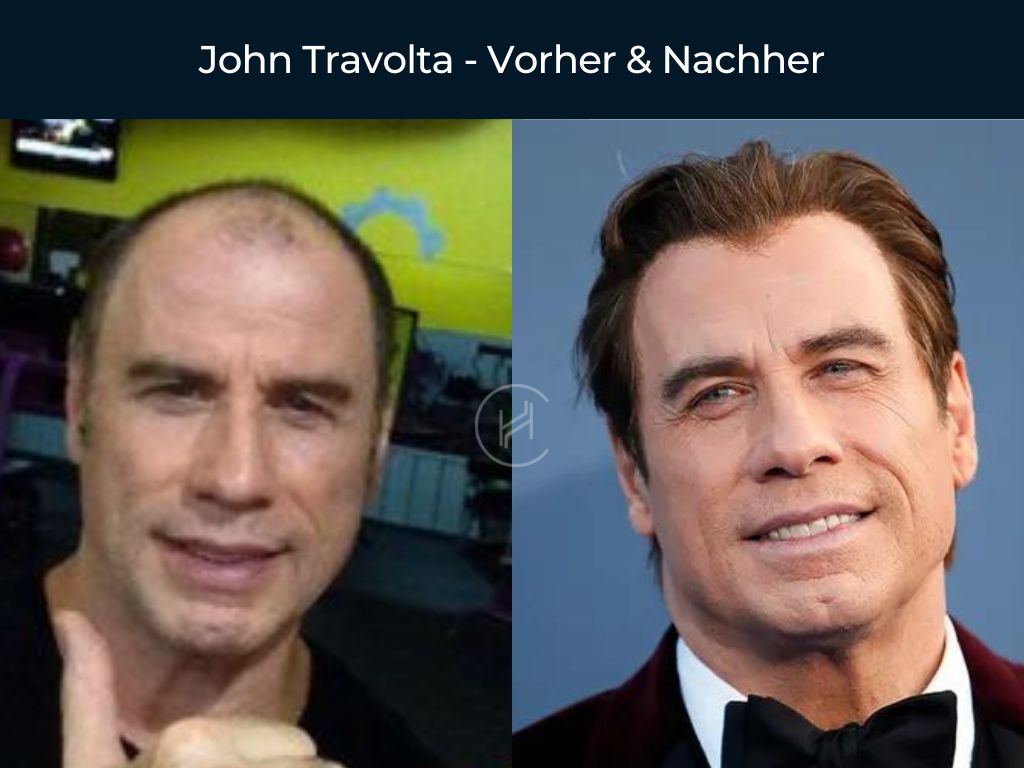 John Travolta - Vorher & Nachher Haartransplantation John Travolta - Vorher & Nachher Haartransplantation